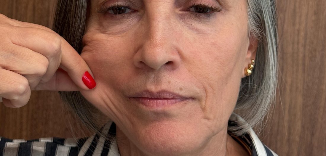 Antes — flacidez facial
