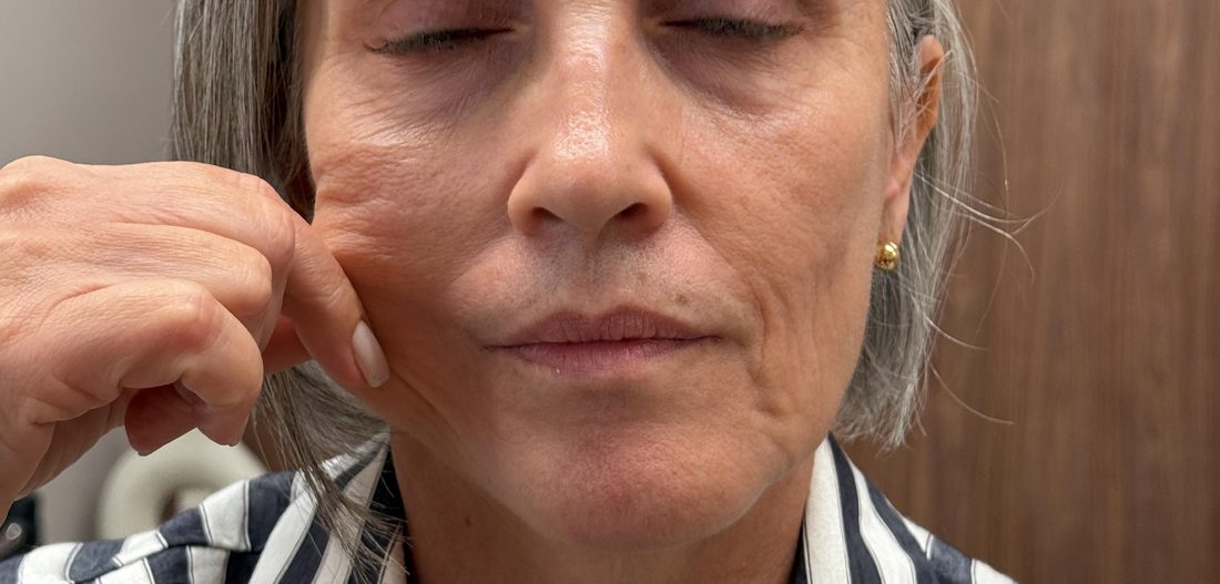 Depois — Liftera e bioestimulador