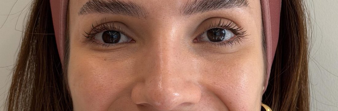 Depois — toxina botulínica na região dos olhos
